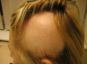 Стимуляция роста волос: эффективные процедуры и методы